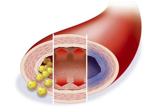 低密度膽固醇超標(biāo)，多久會(huì)影響血管健康？來(lái)看看鹽城康復(fù)醫(yī)院醫(yī)生怎么說(shuō)